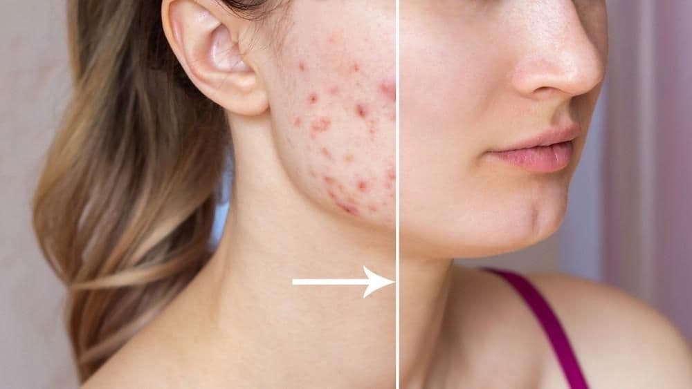 From Breakouts to Confidence: Finding the Right Acne Treatment